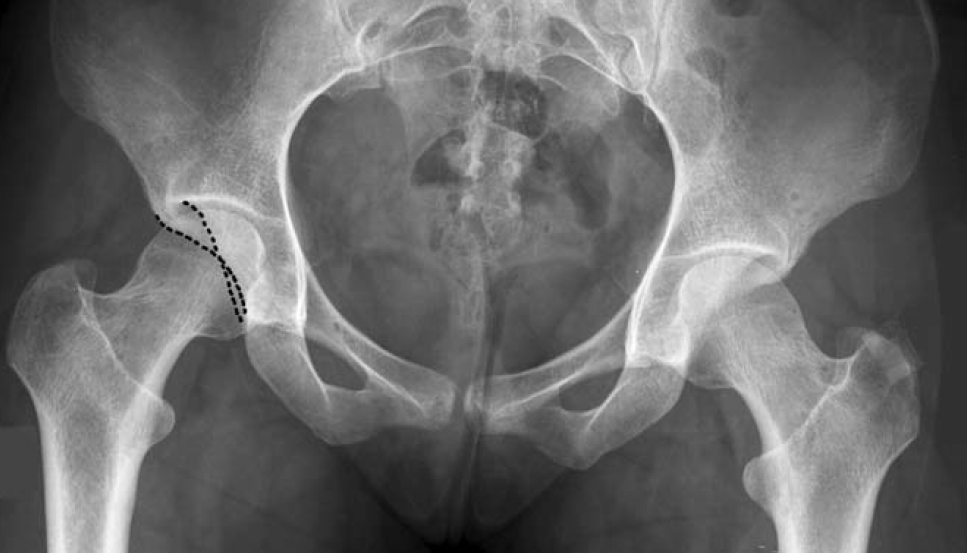 Röntgenbild eines Beckens mit markierter Knochenkontur zur Darstellung eines Hüftimpingements auf der linken Seite.