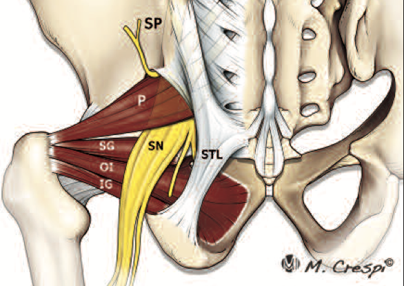 Anatomische Illustration der tiefen Glutealmuskulatur mit dem Piriformis-Muskel und dem Verlauf des Ischiasnervs durch das Becken. Das Bild zeigt mögliche Kompressionsstellen des Nervs, die beim Piriformis-Syndrom eine Rolle spielen können.