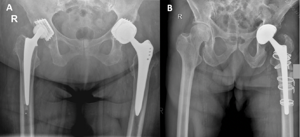 Röntgenaufnahme von zwei Hüft-Totalendoprothesen (Hüft-TEP) mit unterschiedlichen Implantationsmethoden.