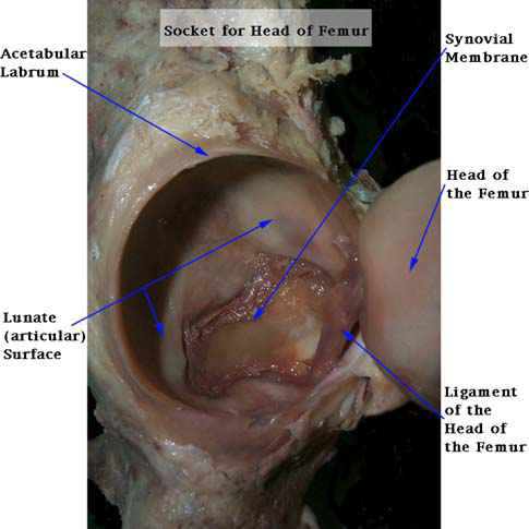 Anatomisches Bild eines geöffneten Hüftgelenks mit markiertem Acetabulum, Labrum, Gelenkkopf und Bändern; relevant zur Veranschaulichung eines Labrumrisses.