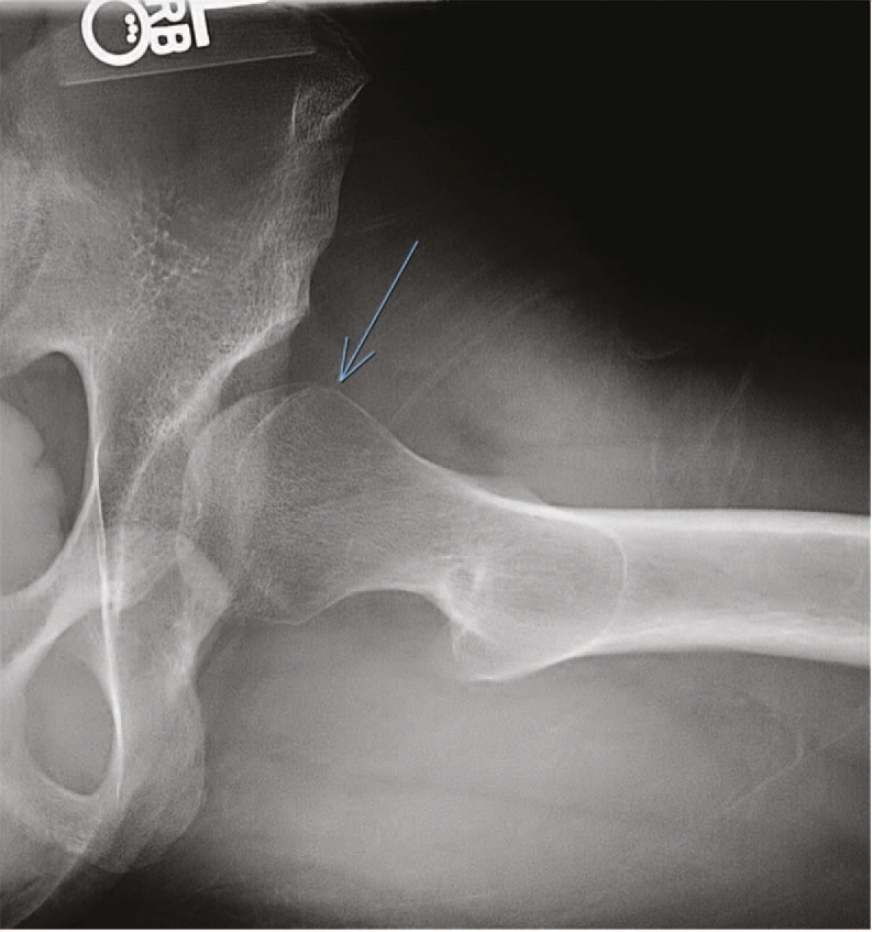 Röntgenbild einer Hüfte mit Pfeilmarkierung im Bereich des Hüftkopfes und Pfannendachs – Hinweis auf strukturelle Veränderungen bei Labrumriss.