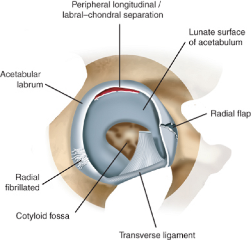 Schematische Darstellung des Hüftgelenks mit verschiedenen Typen eines Labrumrisses, darunter radiale Risse, fibrillierte Strukturen und labral-chondrale Abspaltungen.